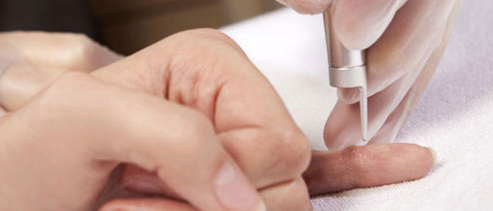 Warts | Skin | Nu Skin Care Clinic | Thanjavur | Taminadu - India. Warts | Skin | Nu Skin Care Clinic | Thanjavur | Taminadu - India.